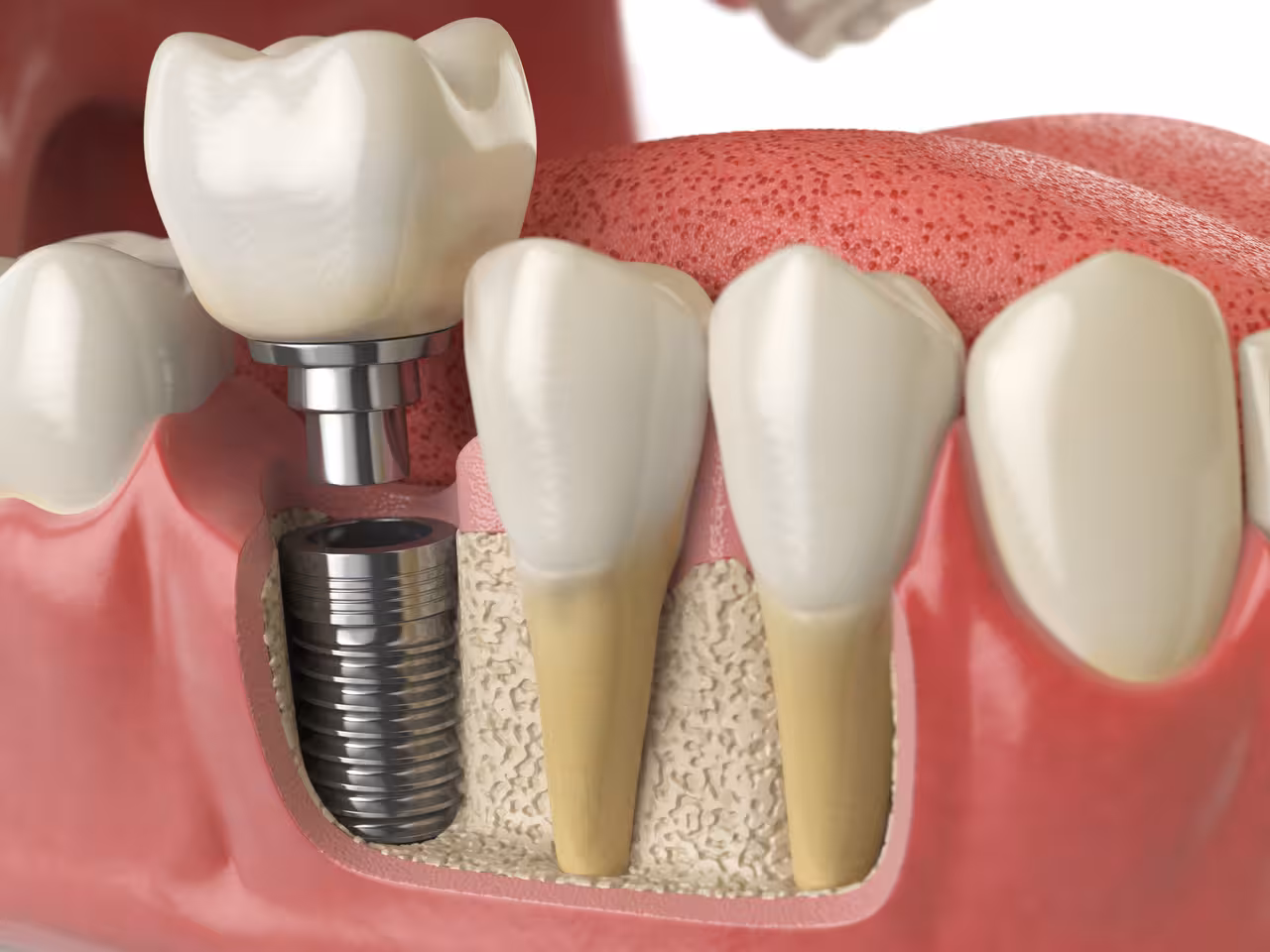 Dental Implants